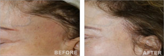 Hair transplantation after a face lift