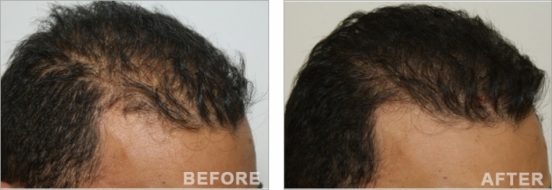 Hair Transplant before and after Beirut Lebanon