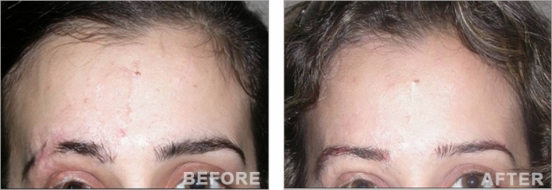 Eyebrow Transplantation