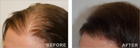 Female Hair Transplantation 2 years