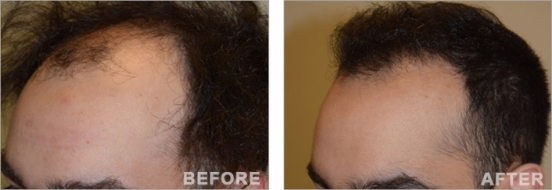 Hair Transplant before and after Beirut Lebanon